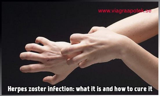 Vattkoppor Symptom